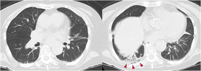 Case report: Severe respiratory failure caused by licorice